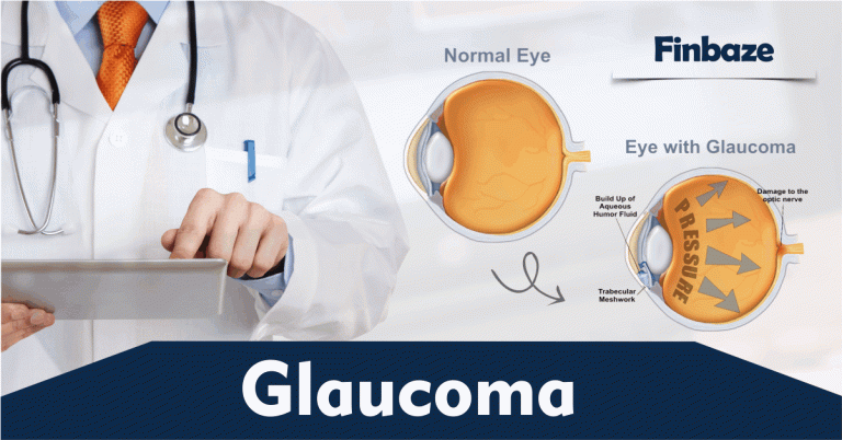 Norland Treatment For Glaucoma - FInbaze